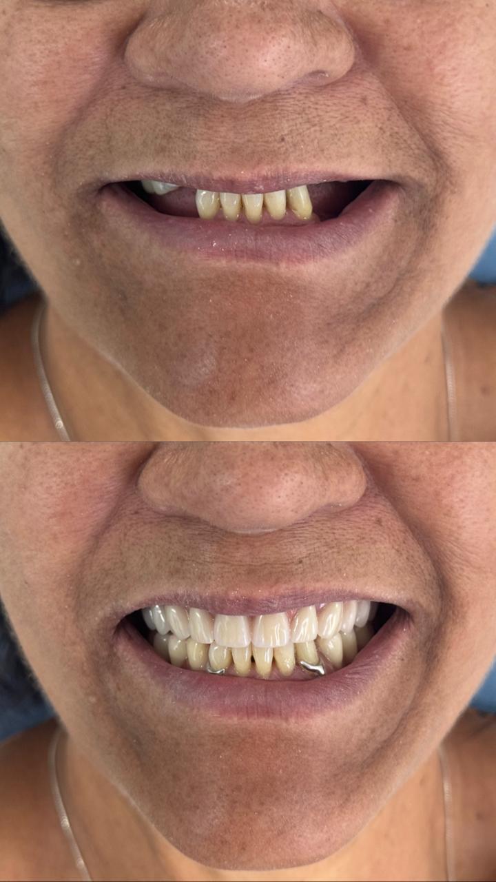 Prótese Sobre Implante - Antes e Depois